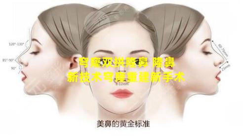 穹窿双拱隆鼻 隆鼻新技术穹窿重建新手术